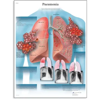 3B Scientific Lungenentzündung Schaubild