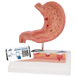 3B Scientific Menschliche Anatomie - Magen mit Magengeschwüren + kostenlose Anatomie App - 3B Smart Anatomy