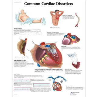 3B Scientific Lehrtaffel laminiert - Common Cardiac Disorders - Englisch