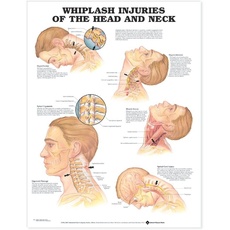 Whiplash Injuries of the Head and Neck Anatomical Chart