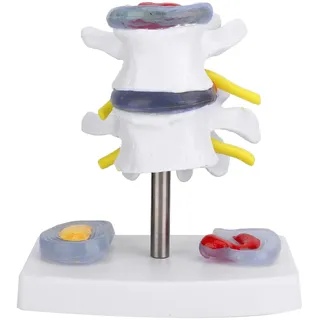 Tyenaza Human Lumbar Vertebrae Model, Skeleton Model Lumbar Vertebrae Model Lendenwirbelmodell Modello di Vertebre lombari umane(Modell des Bandscheibenvorfalls)